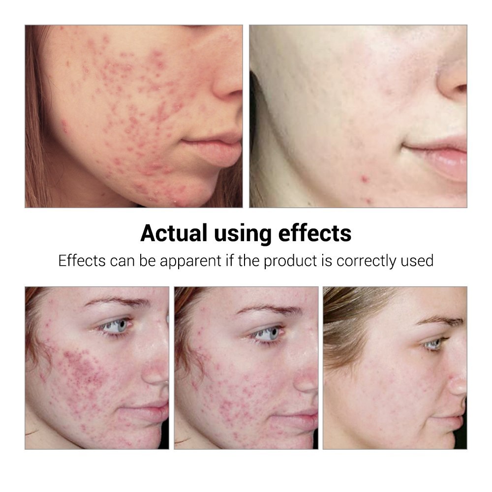 BREYLEE Acne Treatment Serum