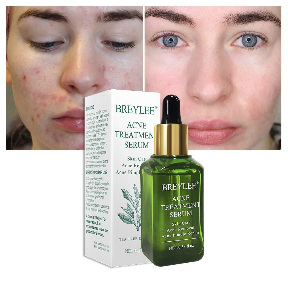 BREYLEE Acne Treatment Serum