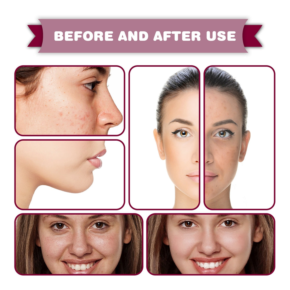 Jaysuing Fruit Acid Essence for Blackheads and Acne
