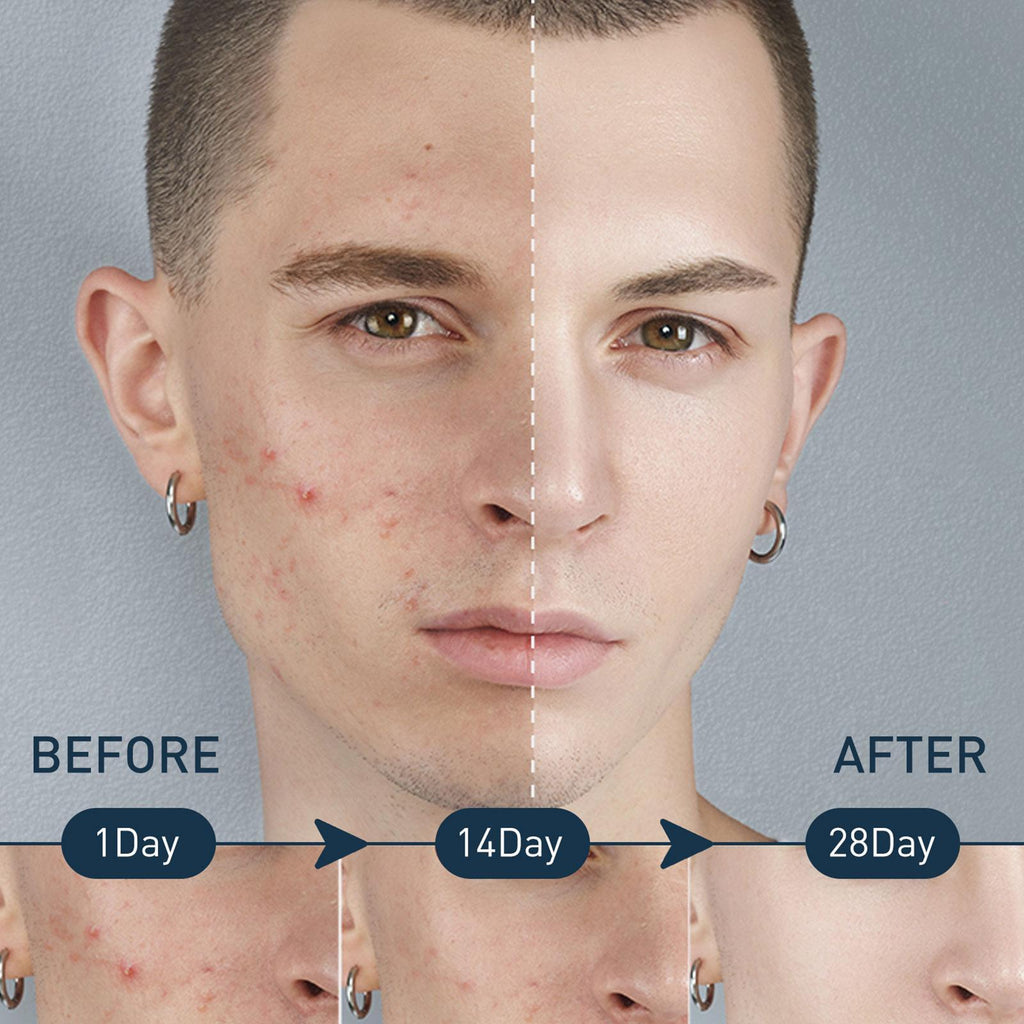 Men's Exfoliating Mousse for Acne and Oil Control