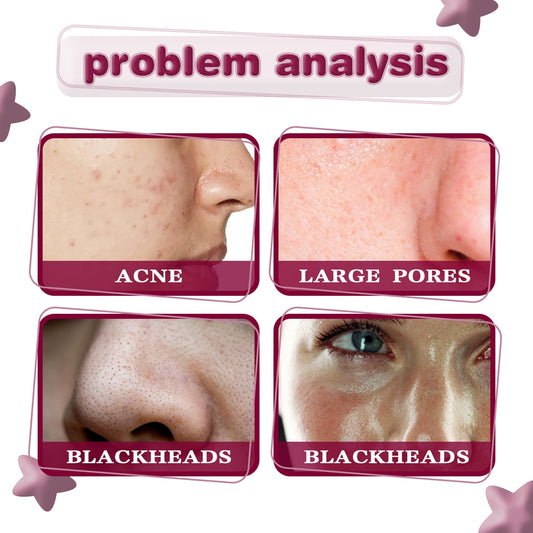 Jaysuing Fruit Acid Essence for Blackheads and Acne